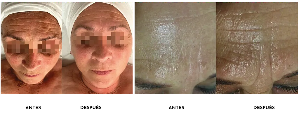 Antes y después 